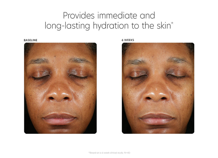 Before and after close-up images of a person's face showing improved skin hydration and texture after using Hyaluronic Acid Boosting Serum | PCA Skin for six weeks.